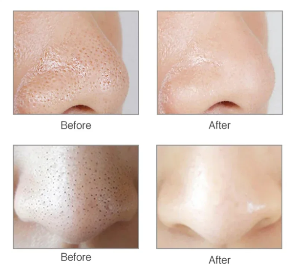 Electric Blackhead Remover 